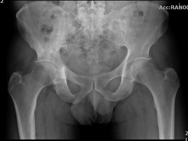 Fig 1. X-ray showing lytic lesion in right acetabulum